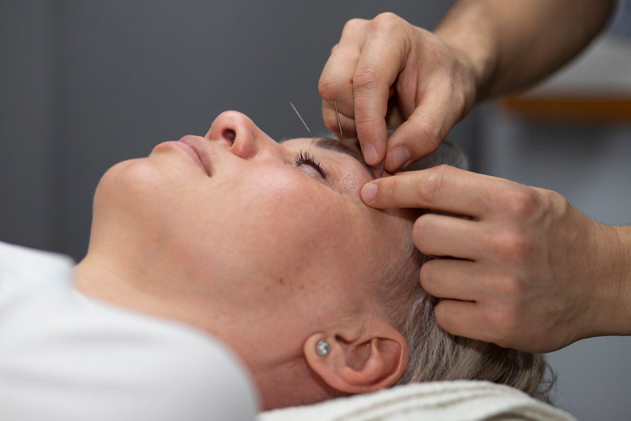 Acupuncture Roanne : insertion d'aiguilles dans le visage