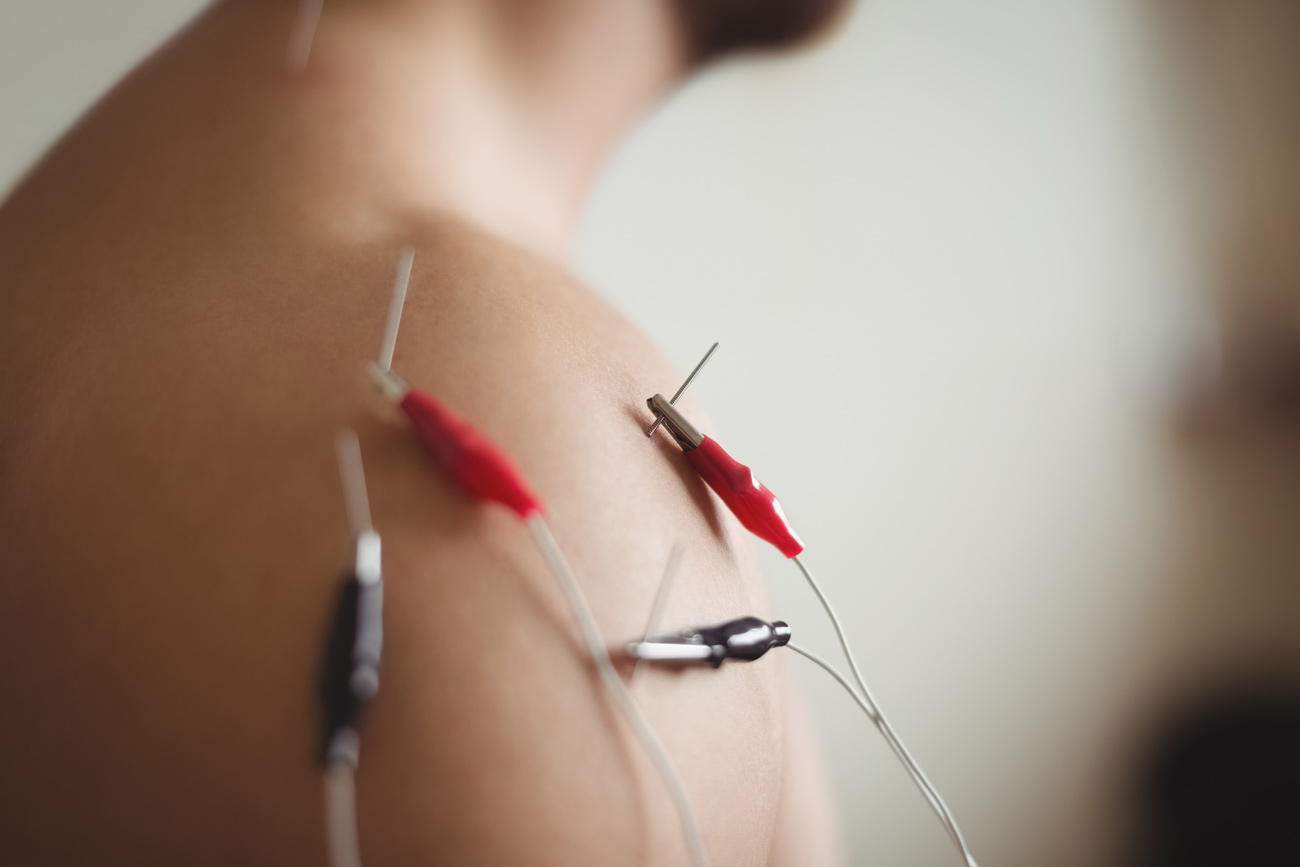 Electro-acupuncture : stimulation électrique par aiguille